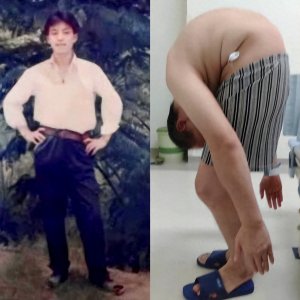 ​“折叠人”李华：骨头被敲断4次，植入22颗钢钉，如今重获新生