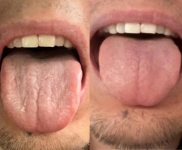 ​一组舌象告诉你 脾肾两虚调理起来 没那么复杂