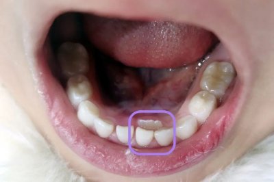 ​孩子长双排牙，只因家长做错这件事！