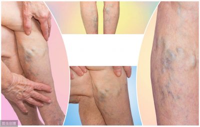 ​静脉曲张的治疗 静脉曲张病因、治疗方案、缓解措施、日常注意这篇文章总结很清